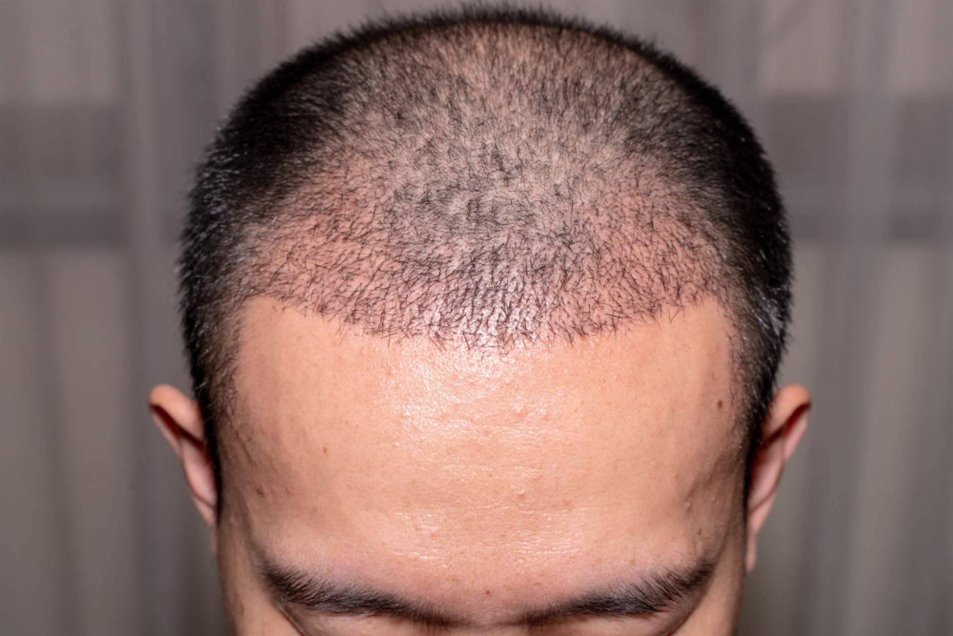 MC360 dispone de expertos en injertos de pelo