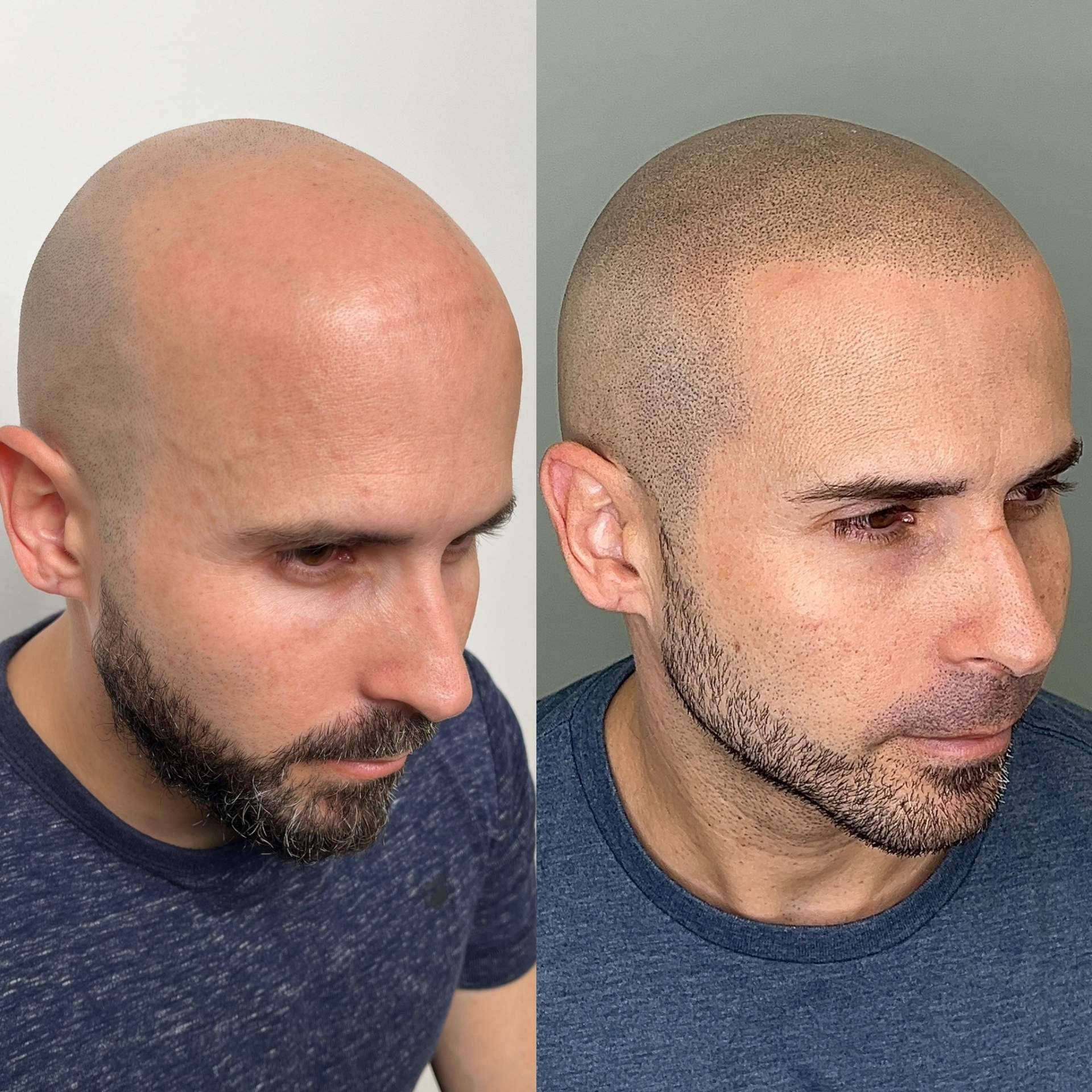 La técnica de Imagia micropigmentacion capilar 'Invisible touch' que conquista a clientes exigentes