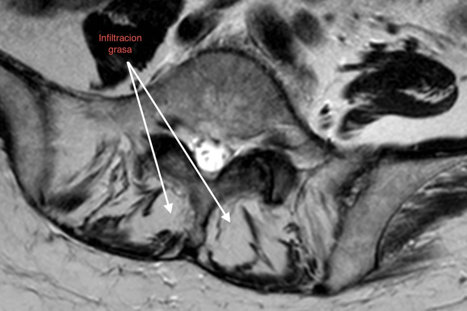 Impacto de la sarcopenia y la infiltración grasa paravertebral en la degeneración del segmento adyacente